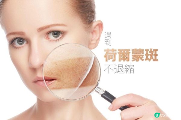 荷爾蒙斑真係咁難搞？打皮秒去斑Pico有無效？