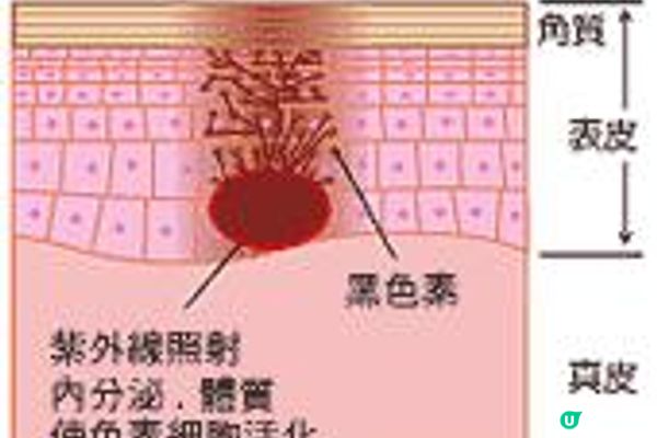 荷爾蒙斑真係咁難搞？打皮秒去斑Pico有無效？