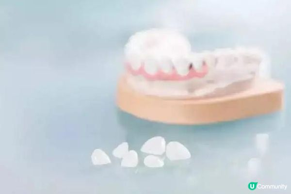 想美白牙齒陶瓷牙貼值唔值得做? + 心得分享