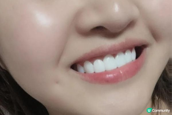想美白牙齒陶瓷牙貼值唔值得做? + 心得分享
