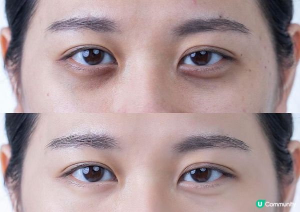 平靚正醫美去眼袋方案推薦：FaceMORE & New Beauty 哪款更能在短時間內見效？最全性價比一覽無遺！小資女靠這款成功K.O眼袋！
