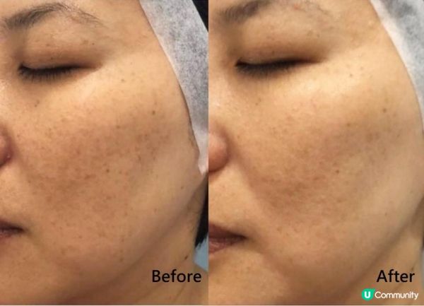 年紀輕輕就有老人斑？去色斑還得靠醫美：INGRID MILLET VS New Beauty 哪家能在短時間內美白勻膚，重新GET無暇白皙膚質？