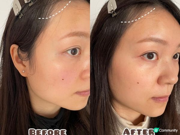 【頭髮再生】CurrentBody Skin LED 光療生髮帽試用效果