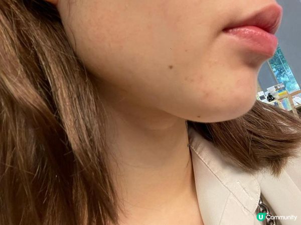 \3年抗痘之旅/ 我嘅暗瘡爛臉心路歷程！抗痘實戰分享～