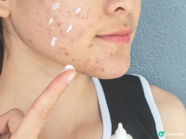 \3年抗痘之旅/ 我嘅暗瘡爛臉心路歷程！抗痘實戰分享～