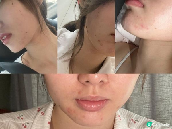\3年抗痘之旅/ 我嘅暗瘡爛臉心路歷程！抗痘實戰分享～