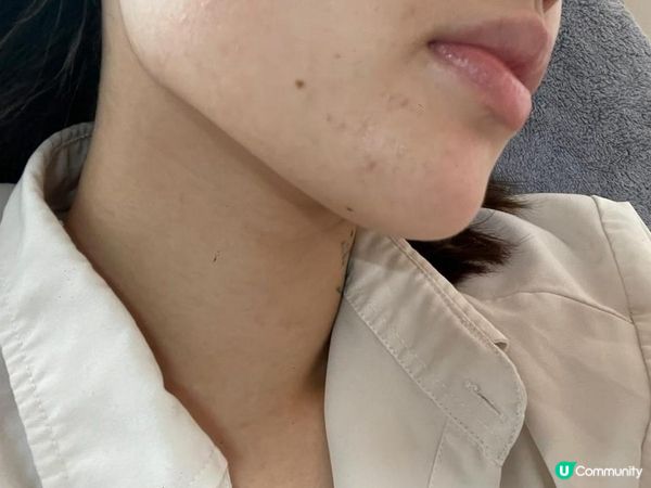 \3年抗痘之旅/ 我嘅暗瘡爛臉心路歷程！抗痘實戰分享～
