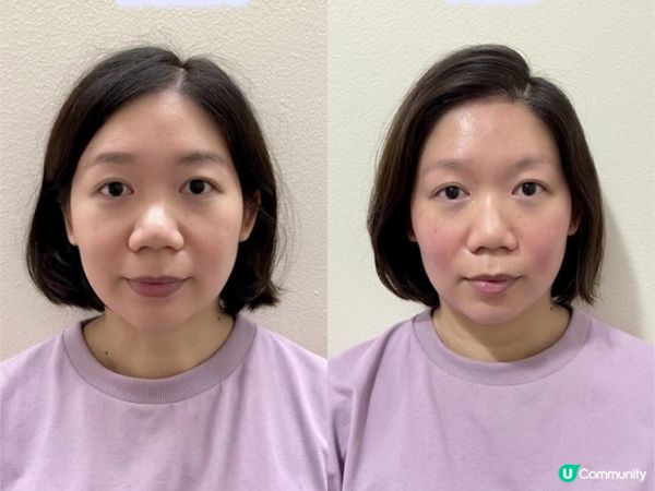 小顏整骨初體驗...即時瘦了4mm！