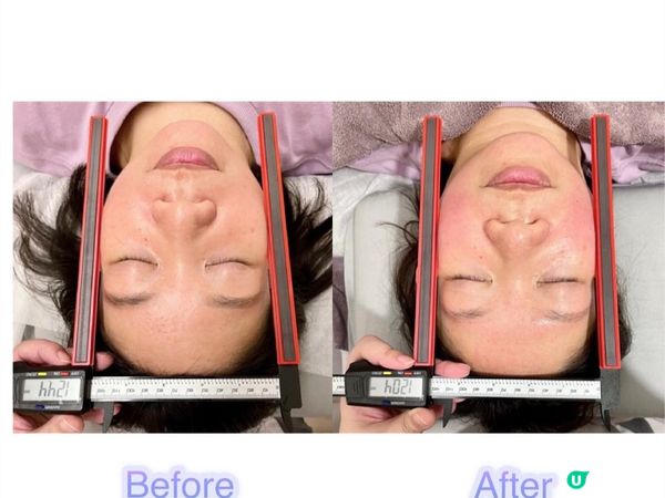 小顏整骨初體驗...即時瘦了4mm！