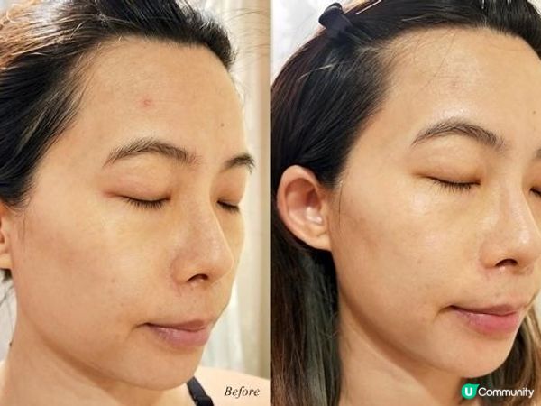 對付M前亂爆瘡 - ALYSSA BEAUTY 肌源28