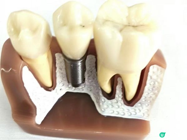My Dental Implant Experience in Shenzhen