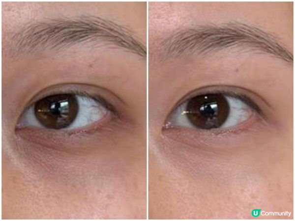 Miracle 18 改善左我黑眼圈問題🐼