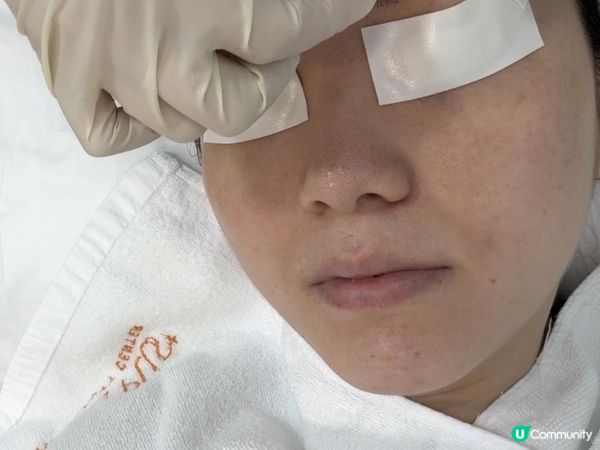 分享: MEDSKIN PLUS【LUTRONIC Spectra 醫學級美白去斑激光】