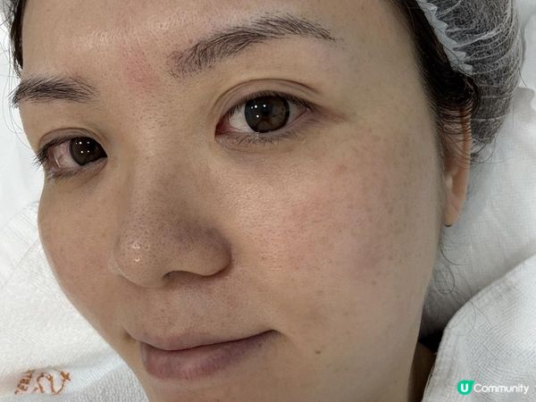 分享: MEDSKIN PLUS【LUTRONIC Spectra 醫學級美白去斑激光】