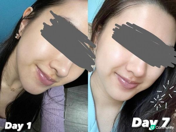 【暗黑醫學報告】MISEL精華搽到塊面變AI濾鏡（附死亡對比圖）