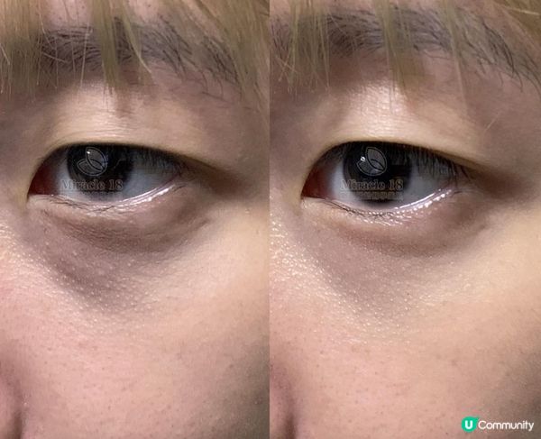 【真實分享】當黑眼圈、眼袋偷走自信，我選擇咗 Miracle 18