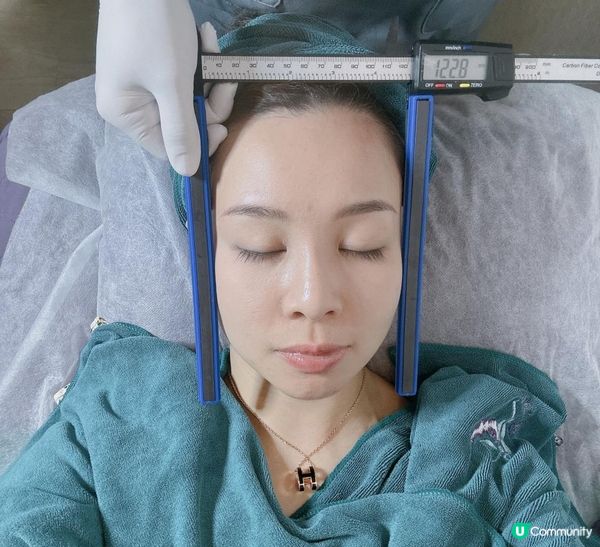 【YOU SKY BEAUTY】初試日式小顏矯正術