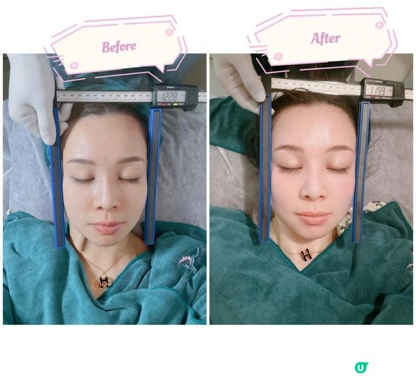 【YOU SKY BEAUTY】初試日式小顏矯正術