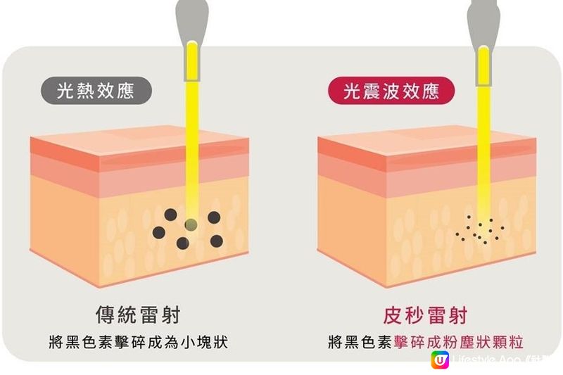 去斑去到皮膚都好咗？皮秒去斑的威力遠超過你想像！