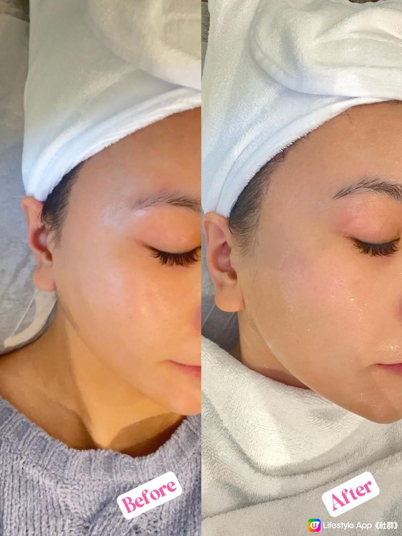 女人新年三寶之一：facial ！ 收毛孔大作戰 Fractional CO2 Laser (分段式二氧化碳激光) 